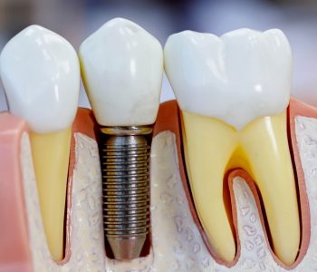 Implantes Dentários - Sayd Odontologia