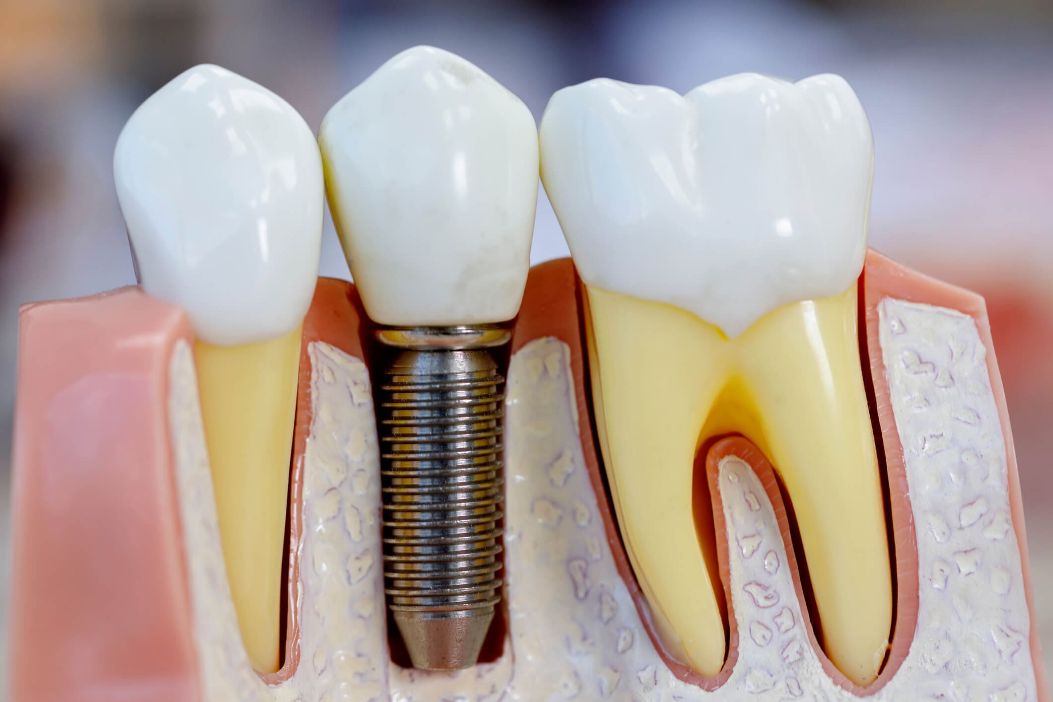 Implantes Dentários - Sayd Odontologia