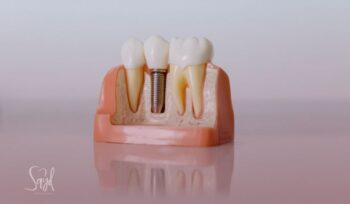Implante dentário dói?