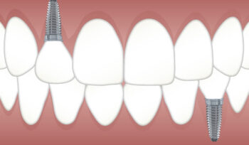 Quais as vantagens do implante dentário