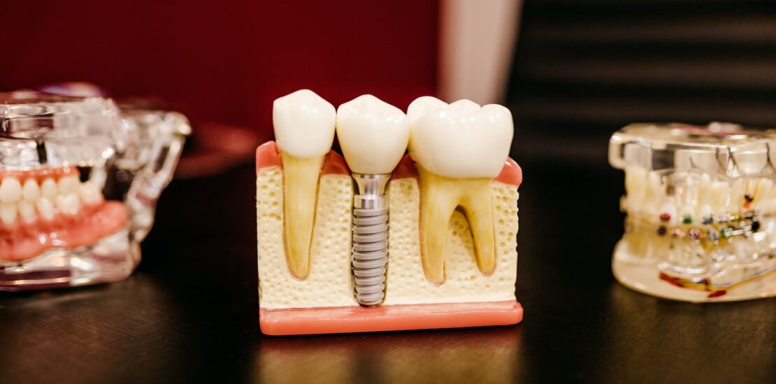 Os Benefícios dos Implantes Dentários