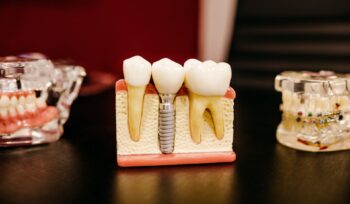 Os Benefícios dos Implantes Dentários
