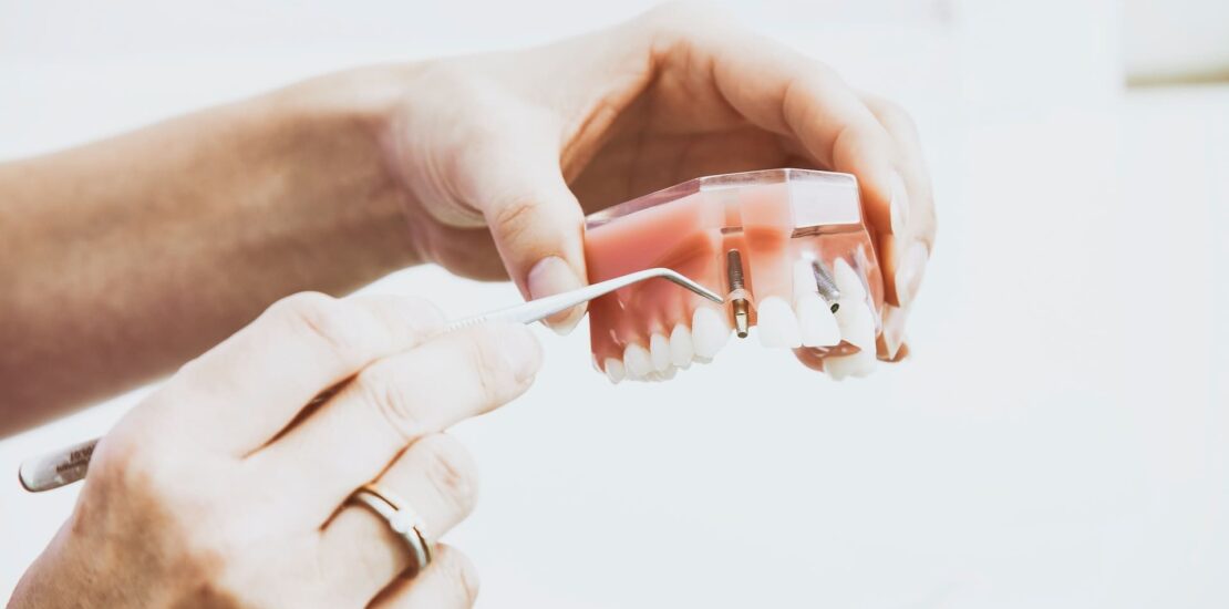 O Que São Implantes Dentários?