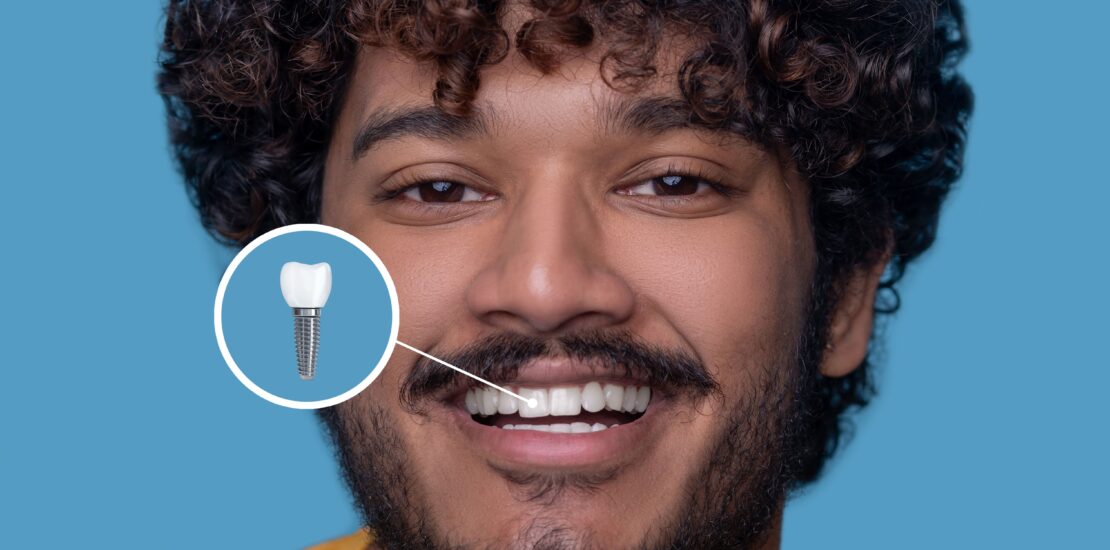 Questões frequentes sobre implantes dentários e Invisalign | Sayd Odontologia
