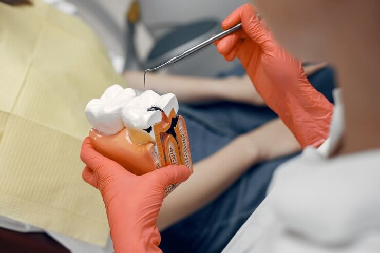 Cáries dentárias: como prevenir e tratar para um sorriso saudável | Sayd Odontologia