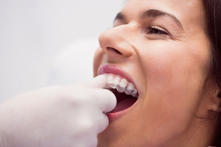 Invisalign: o tratamento revolucionário para um sorriso invisível | Invisalign