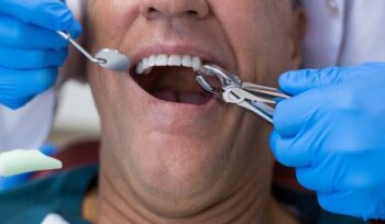 Sem dor, sem medo: tudo sobre exodontia e a remoção de dentes | Sayd Odontologia