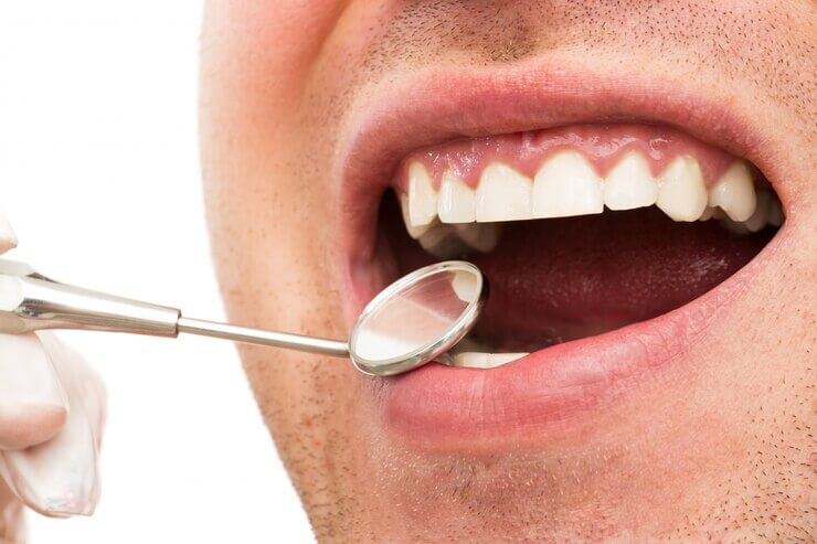 Gengivectomia: o que é e quando é necessária para sua saúde bucal | Sayd Odontologia